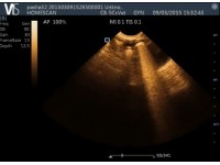 ULTRASOUND ARTEFACTS