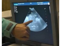 BOWEL VRS PREGNANCY: A COMMON BEGINNERS' PITFALL