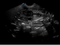 ULTRASOUND AND GUT RELATED CONDITIONS: HOW CAN ULTRASOUND HELP WITH A SNEAK PREVIEW INTO THE FUTURE
