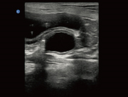 Canine cyst taken on the Ebit50 veterinary ultrasound scanner